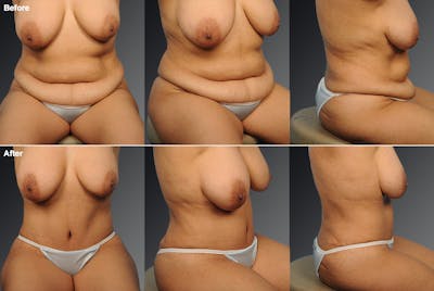 Tummy Tuck Before & After Gallery - Patient 105840777 - Image 1