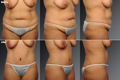 Tummy Tuck Before & After Gallery - Patient 105840780 - Image 1
