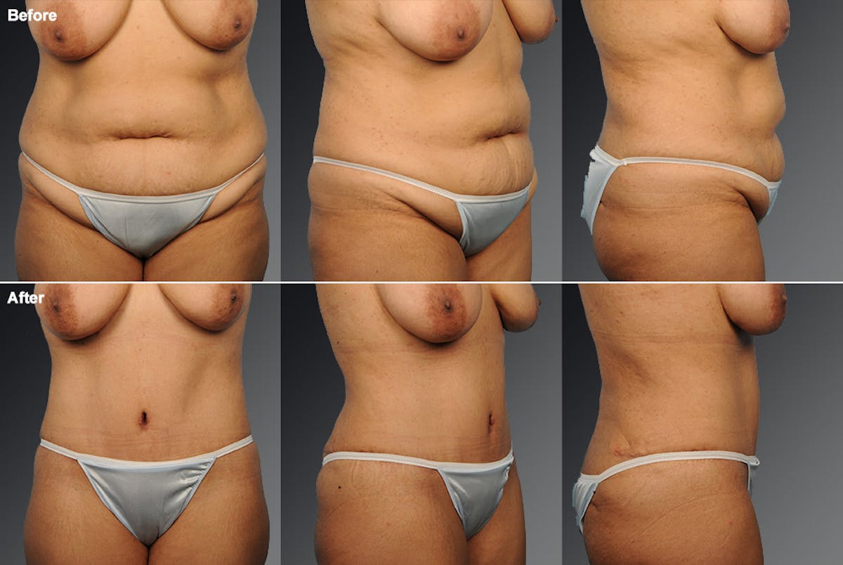Tummy Tuck Before & After Gallery - Patient 105840780 - Image 1
