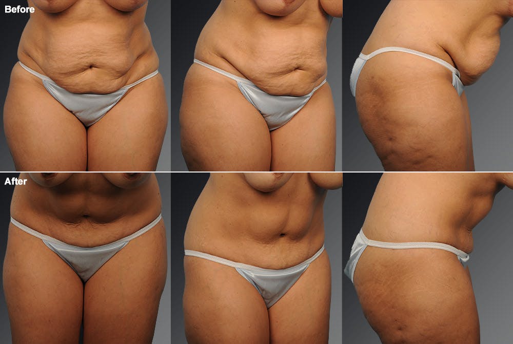Tummy Tuck Before & After Gallery - Patient 105840783 - Image 1