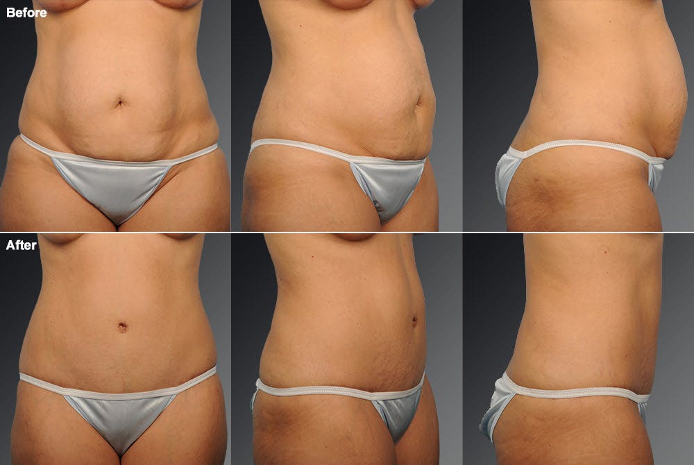 Tummy Tuck Before & After Gallery - Patient 105840784 - Image 1