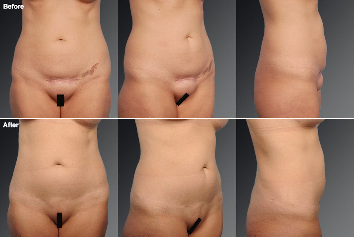 Tummy Tuck Before & After Gallery - Patient 105840785 - Image 1
