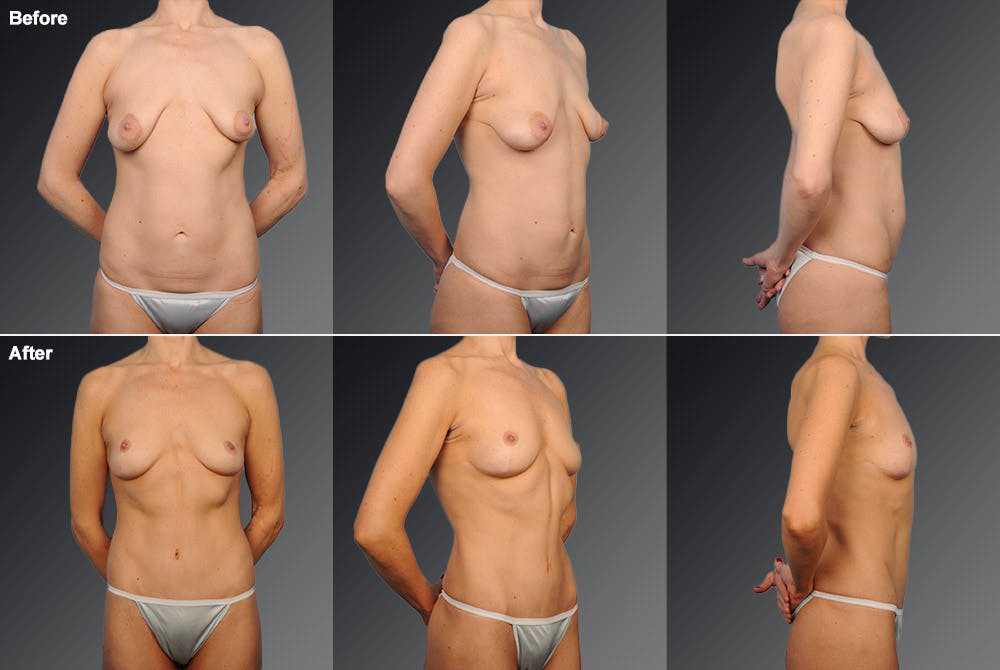 Tummy Tuck Before & After Gallery - Patient 105840786 - Image 1