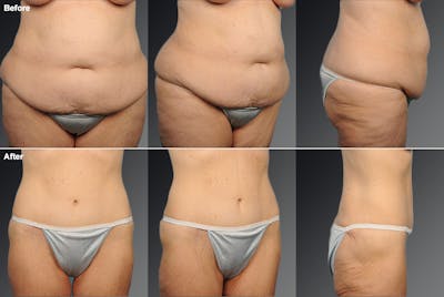 Tummy Tuck Before & After Gallery - Patient 105840788 - Image 1
