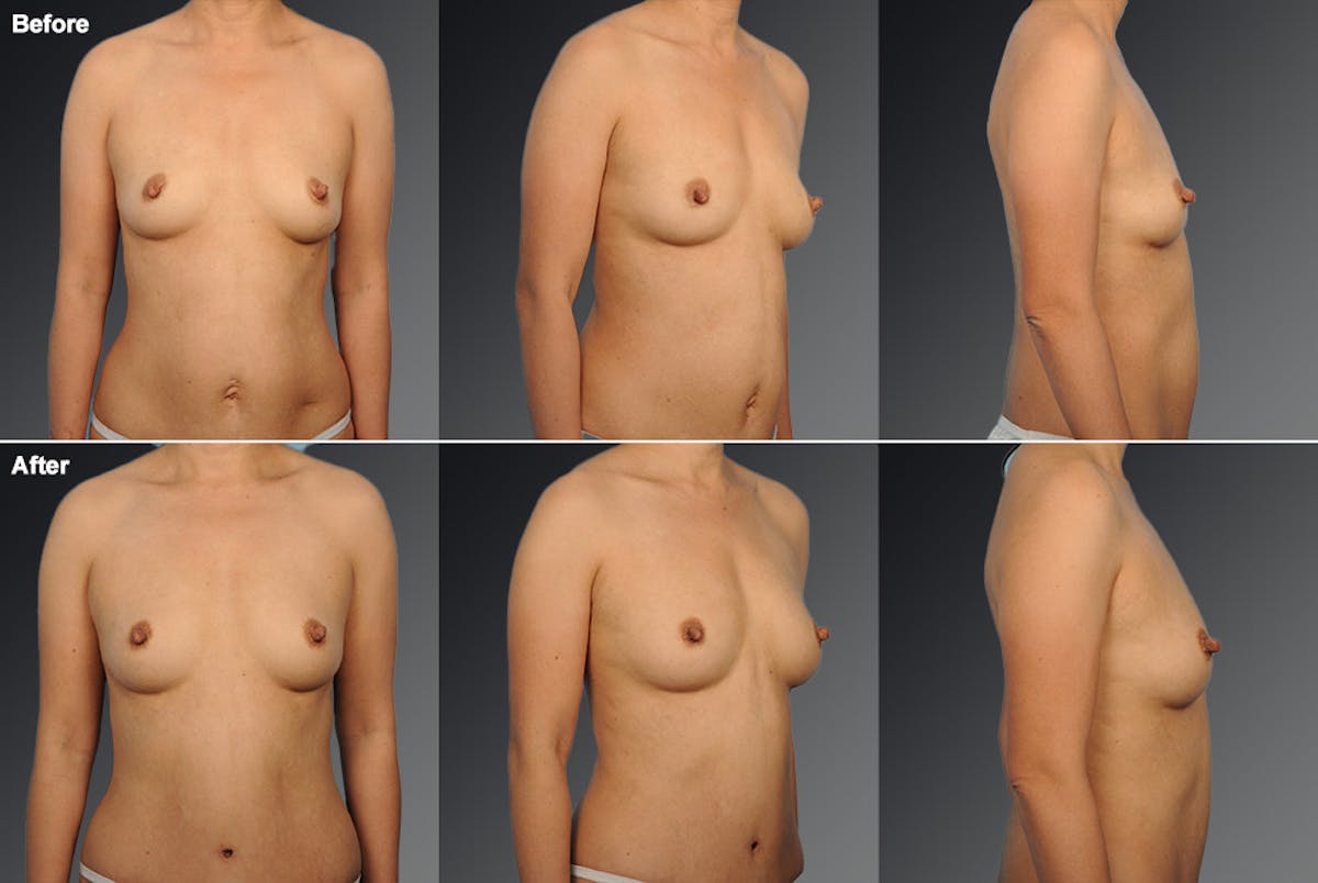 Tummy Tuck Before & After Gallery - Patient 105840789 - Image 1