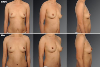 Tummy Tuck Before & After Gallery - Patient 105840789 - Image 1