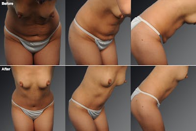 Tummy Tuck Before & After Gallery - Patient 105840794 - Image 1