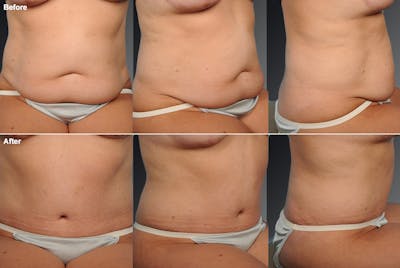 Tummy Tuck Before & After Gallery - Patient 105840797 - Image 1