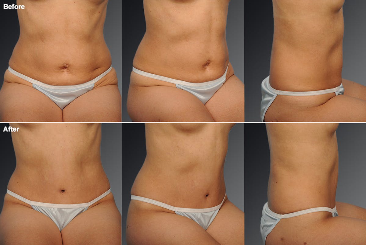 Tummy Tuck Before & After Gallery - Patient 105840798 - Image 1