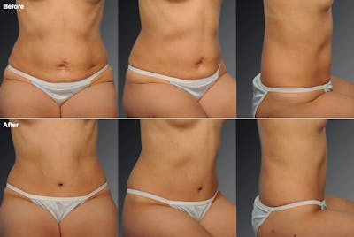 Tummy Tuck Before & After Gallery - Patient 105840798 - Image 1
