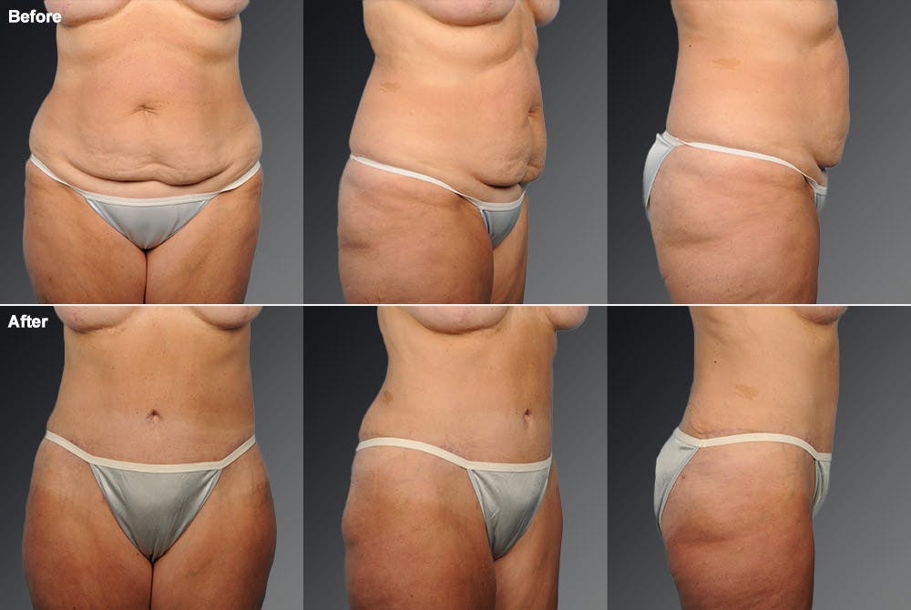 Tummy Tuck Before & After Gallery - Patient 105840801 - Image 1