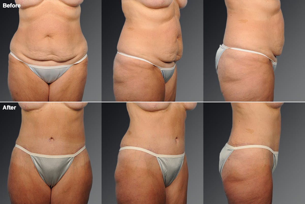 Tummy Tuck Before & After Gallery - Patient 105840801 - Image 1