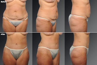 Tummy Tuck Before & After Gallery - Patient 105840801 - Image 1