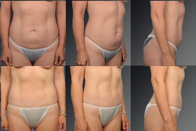 Tummy Tuck Before & After Gallery - Patient 105840802 - Image 1