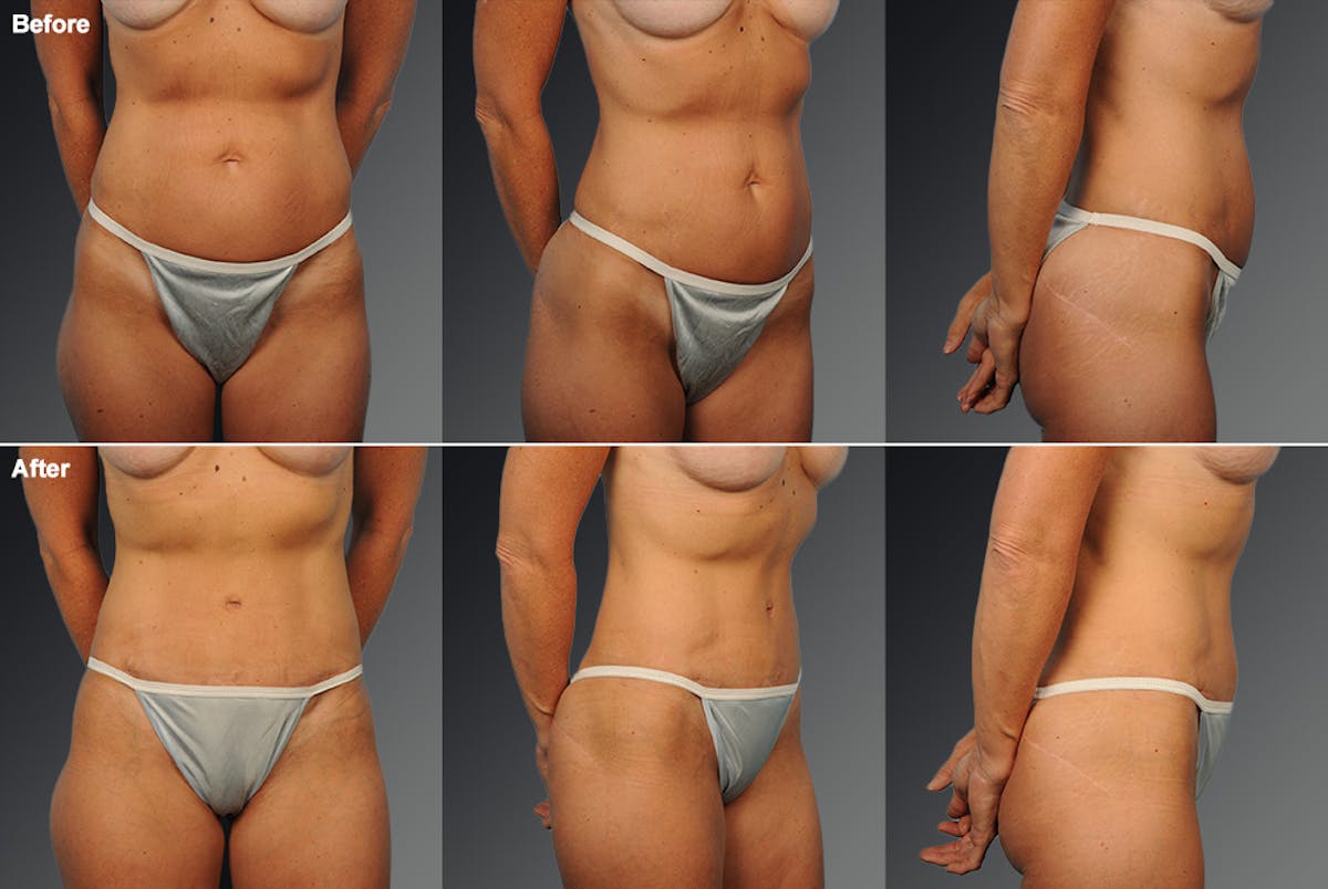 Tummy Tuck Before & After Gallery - Patient 105840805 - Image 1