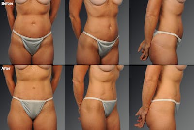 Tummy Tuck Before & After Gallery - Patient 105840805 - Image 1
