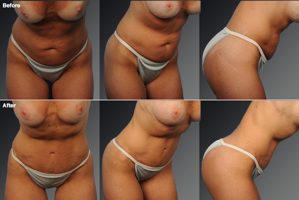 Tummy Tuck Before & After Gallery - Patient 105840806 - Image 1