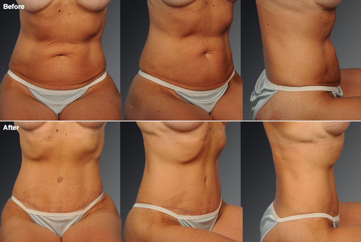 Tummy Tuck Before & After Gallery - Patient 105840807 - Image 1
