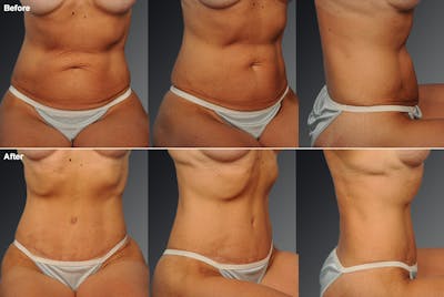 Tummy Tuck Before & After Gallery - Patient 105840807 - Image 1