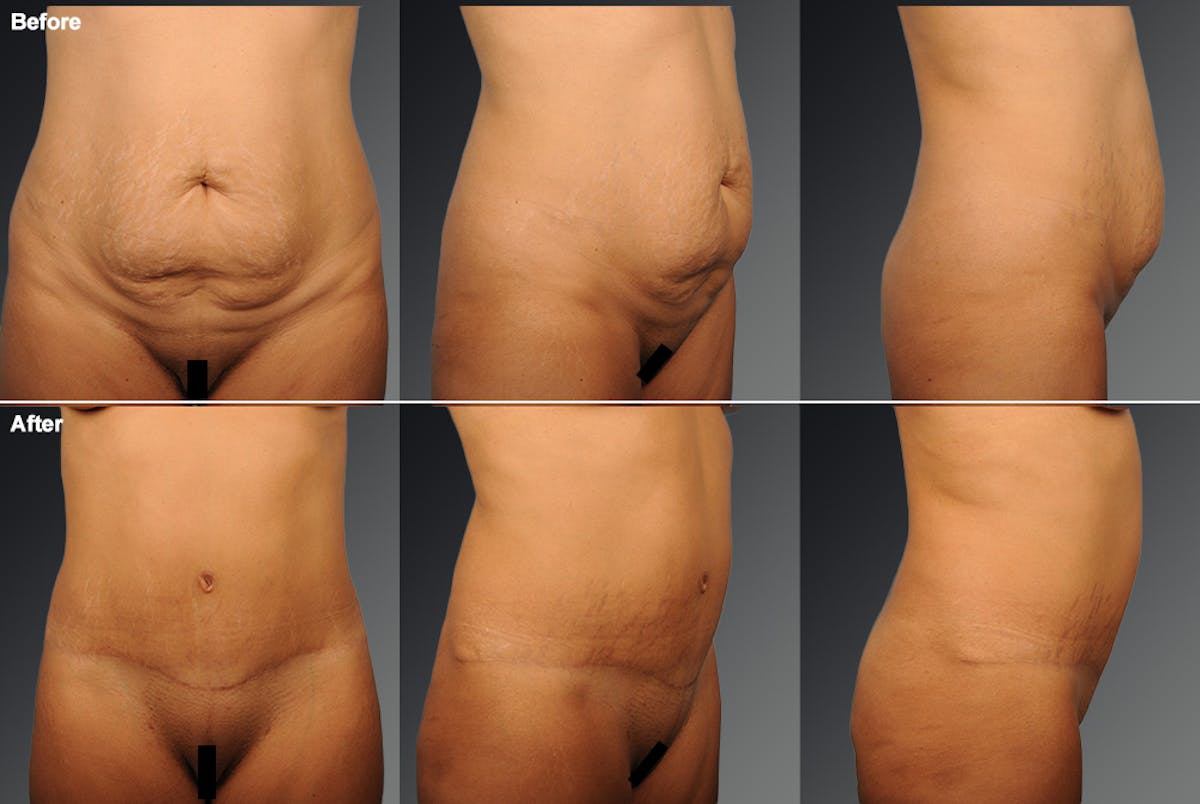 Tummy Tuck Before & After Gallery - Patient 105840808 - Image 1