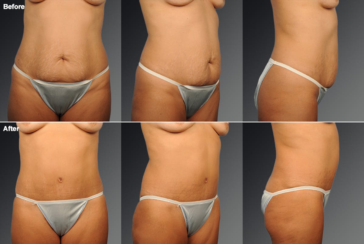 Tummy Tuck Before & After Gallery - Patient 105840811 - Image 1