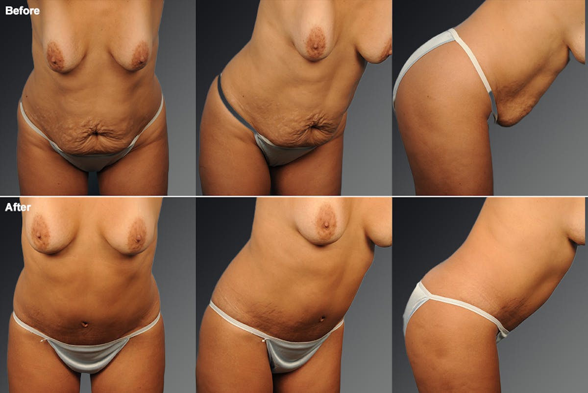 Tummy Tuck Before & After Gallery - Patient 105840812 - Image 1