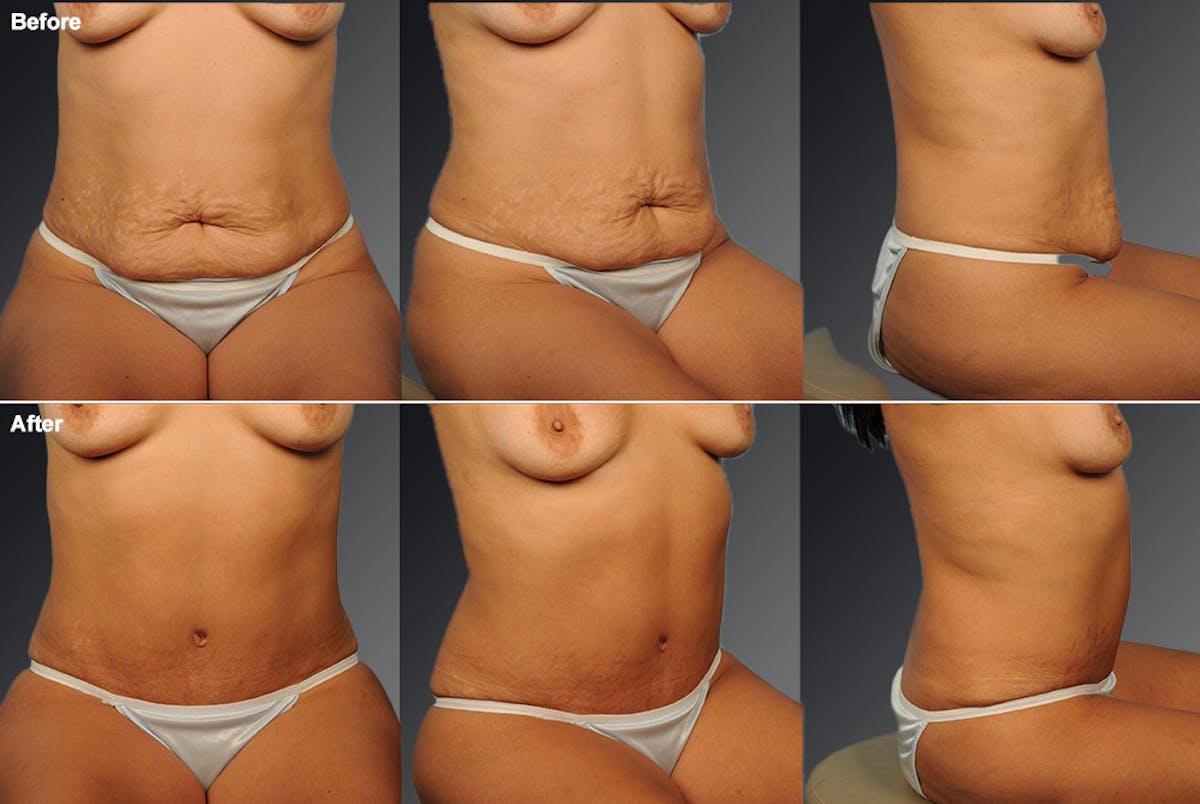 Tummy Tuck Before & After Gallery - Patient 105840813 - Image 1