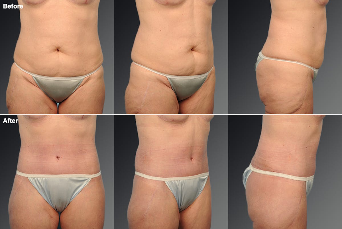 Tummy Tuck Before & After Gallery - Patient 105840814 - Image 1