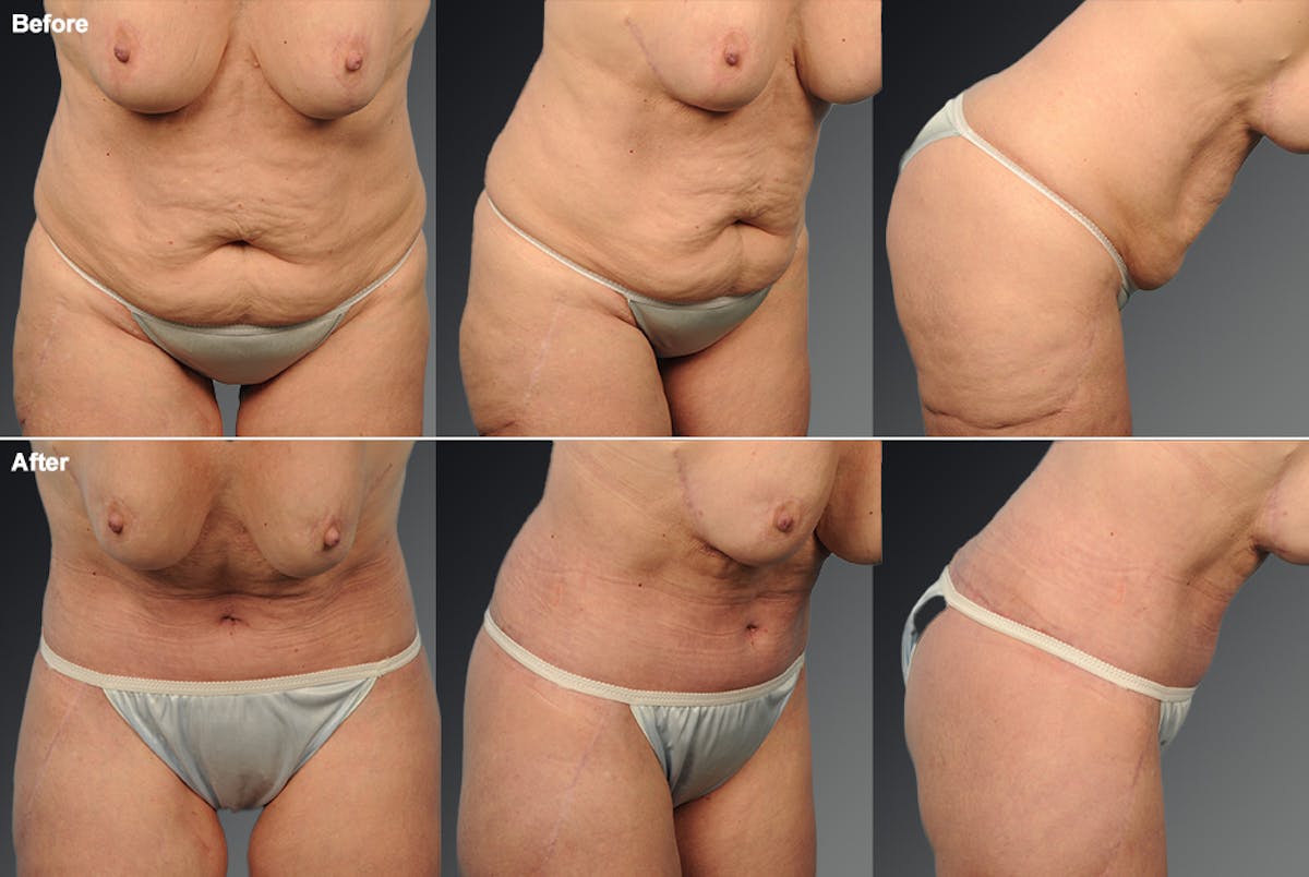 Tummy Tuck Before & After Gallery - Patient 105840815 - Image 1