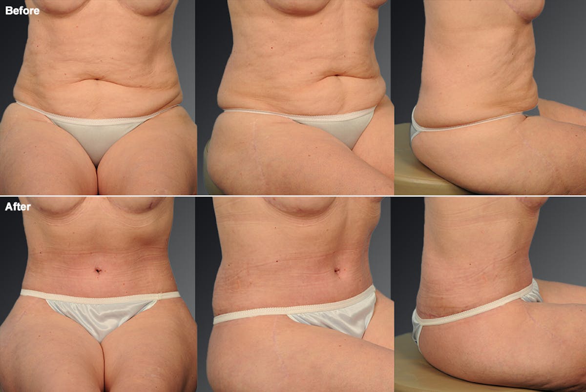 Tummy Tuck Before & After Gallery - Patient 105840817 - Image 1