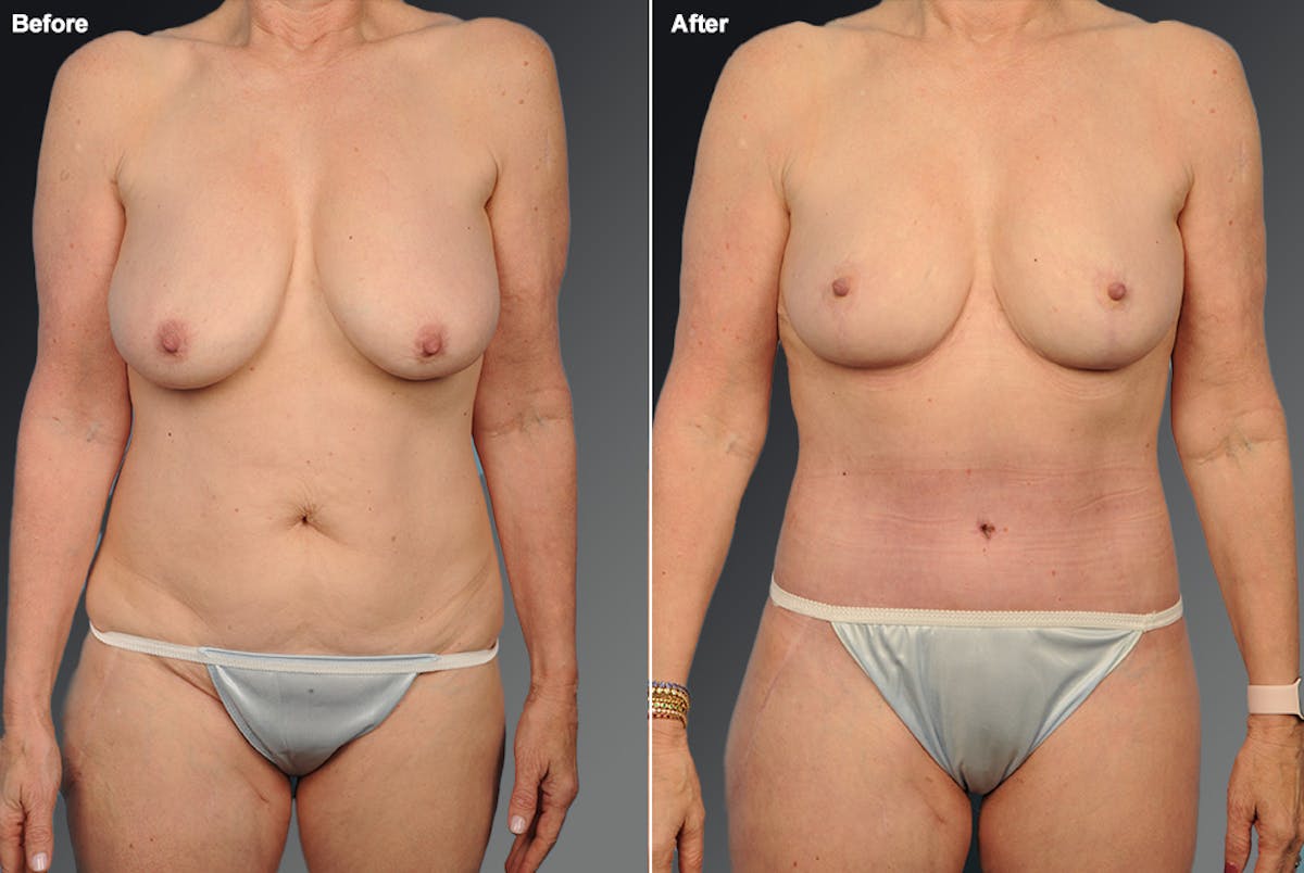 Tummy Tuck Before & After Gallery - Patient 105840819 - Image 1