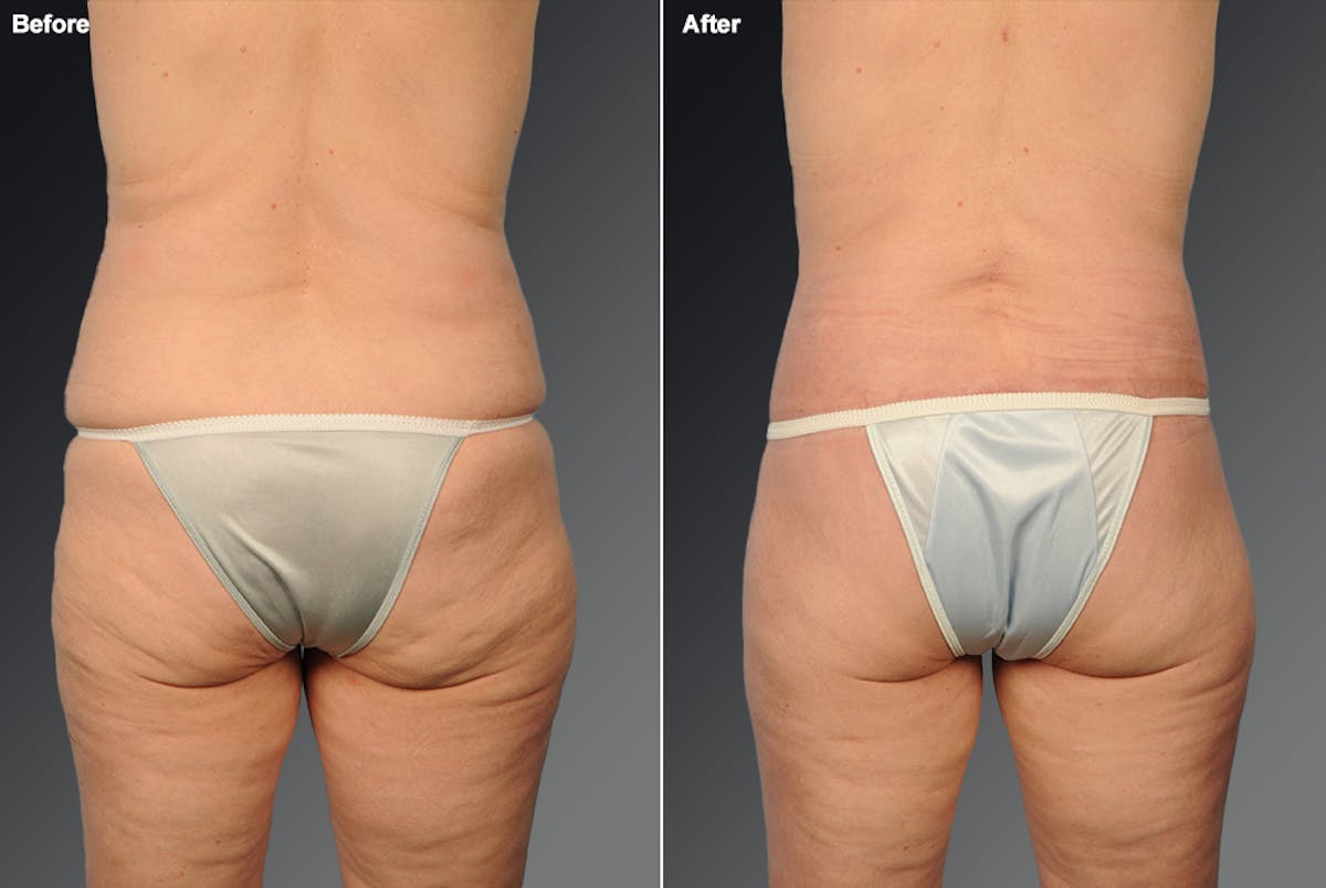 Tummy Tuck Before & After Gallery - Patient 105840820 - Image 1