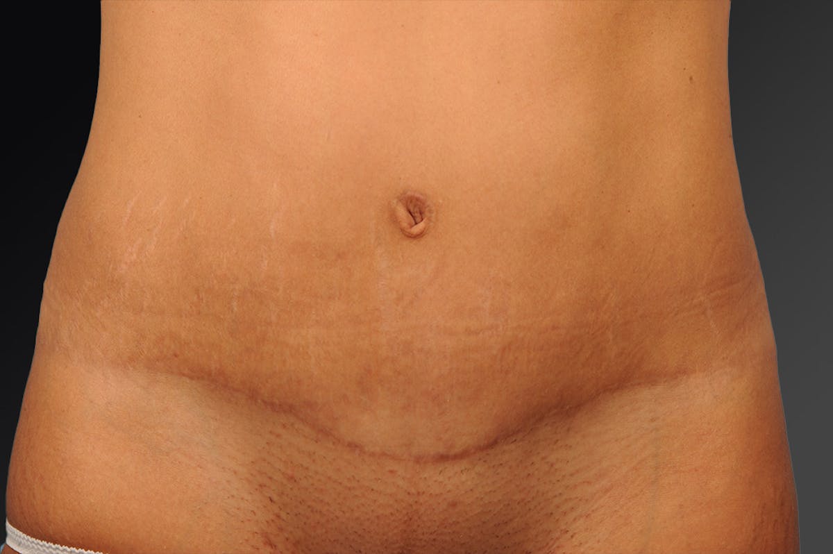 Tummy Tuck Before & After Gallery - Patient 105840822 - Image 1