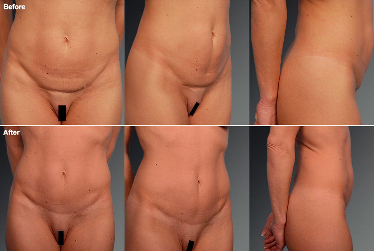 Tummy Tuck Before & After Gallery - Patient 105840845 - Image 1