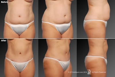 Tummy Tuck Before & After Gallery - Patient 105840846 - Image 1