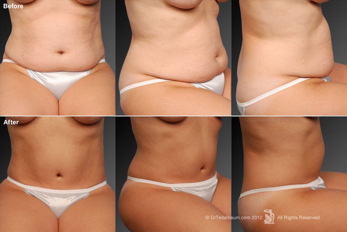 Tummy Tuck Before & After Gallery - Patient 105840847 - Image 1