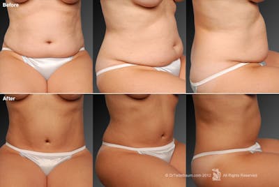 Tummy Tuck Before & After Gallery - Patient 105840847 - Image 1