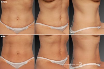 Tummy Tuck Before & After Gallery - Patient 105840853 - Image 1