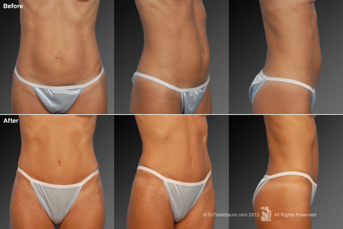 Tummy Tuck Before & After Gallery - Patient 105840855 - Image 1