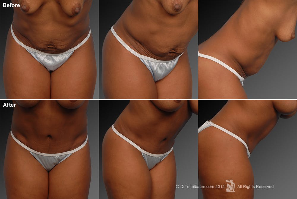 Tummy Tuck Before & After Gallery - Patient 105840856 - Image 1
