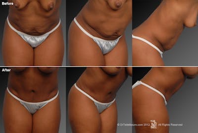 Tummy Tuck Before & After Gallery - Patient 105840856 - Image 1