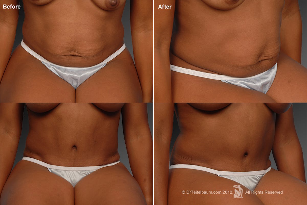 Tummy Tuck Before & After Gallery - Patient 105840859 - Image 1