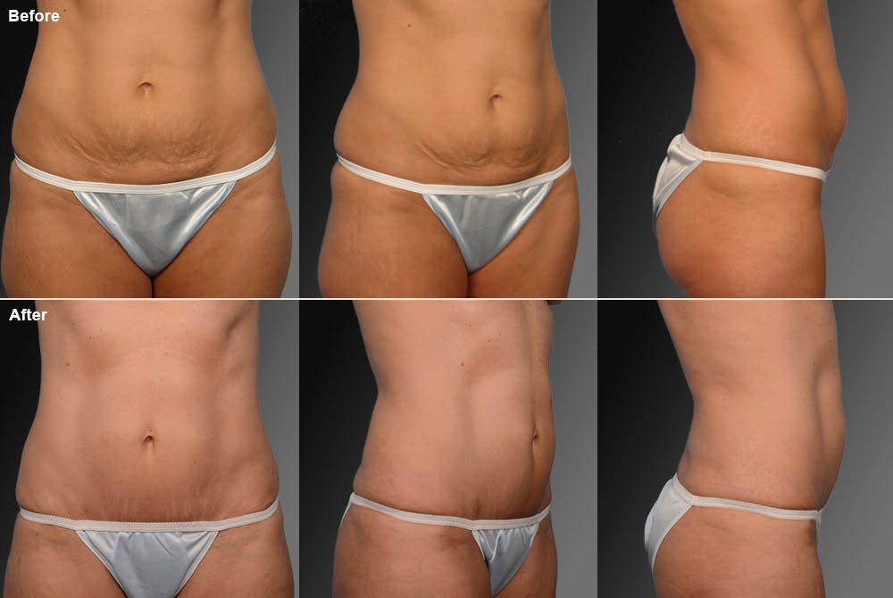 Tummy Tuck Before & After Gallery - Patient 105840860 - Image 1