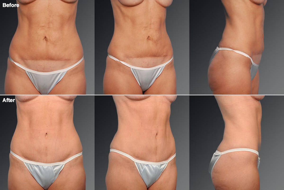 Tummy Tuck Before & After Gallery - Patient 105840866 - Image 1