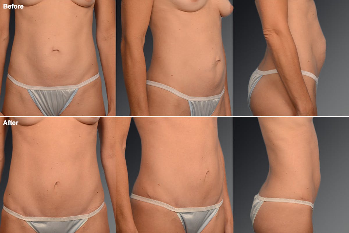 Tummy Tuck Before & After Gallery - Patient 105840870 - Image 1