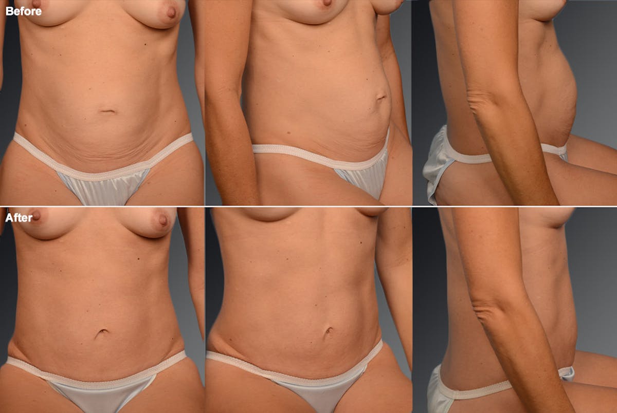 Tummy Tuck Before & After Gallery - Patient 105840871 - Image 1