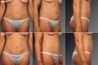 Tummy Tuck Before & After Gallery - Patient 105840873 - Image 1