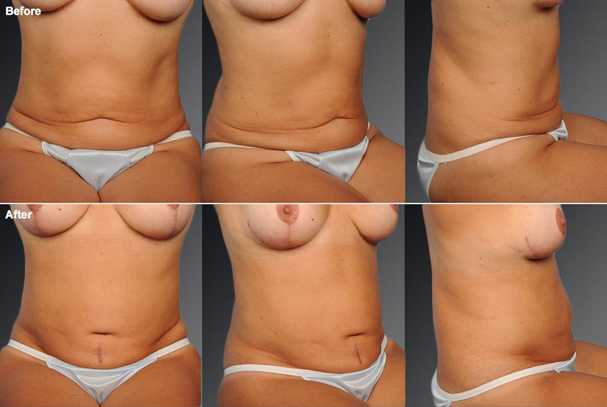 Tummy Tuck Before & After Gallery - Patient 105840874 - Image 1