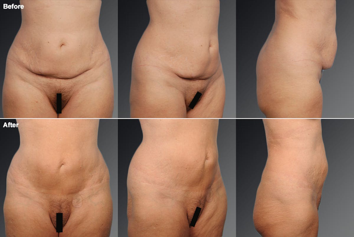 Tummy Tuck Before & After Gallery - Patient 105844367 - Image 1
