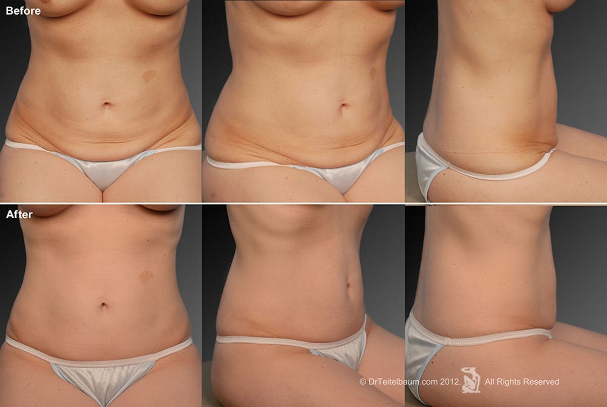 Tummy Tuck Before & After Gallery - Patient 105844368 - Image 1